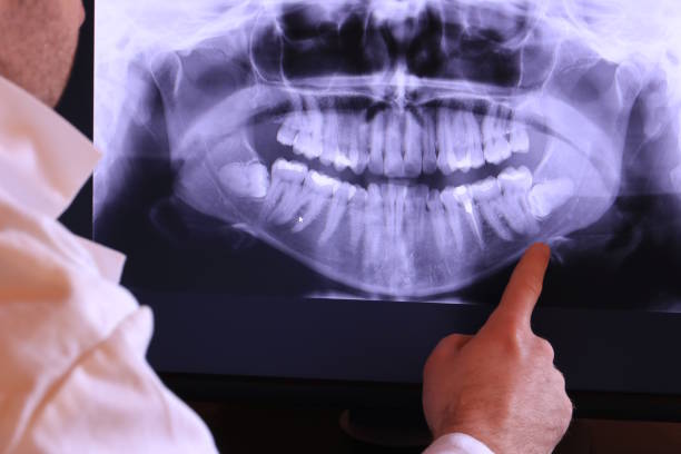 Best Emergency Wisdom Teeth Removal in Fulton, TX