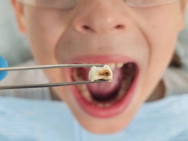 Best Emergency Wisdom Teeth Removal in Fulton, TX