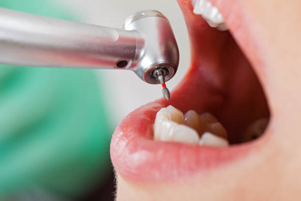 Best Emergency Tooth Extraction in Fulton, TX
